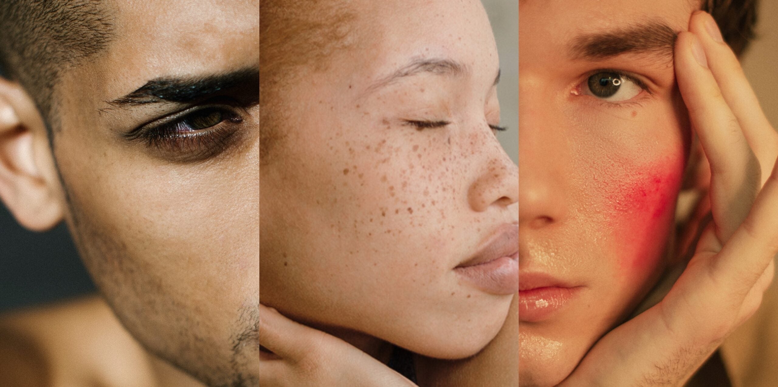 Under-eye circles, freckles, sunburns: Formerly ‘undesirable’ skin traits are now desirable (the reason why might surprise you)