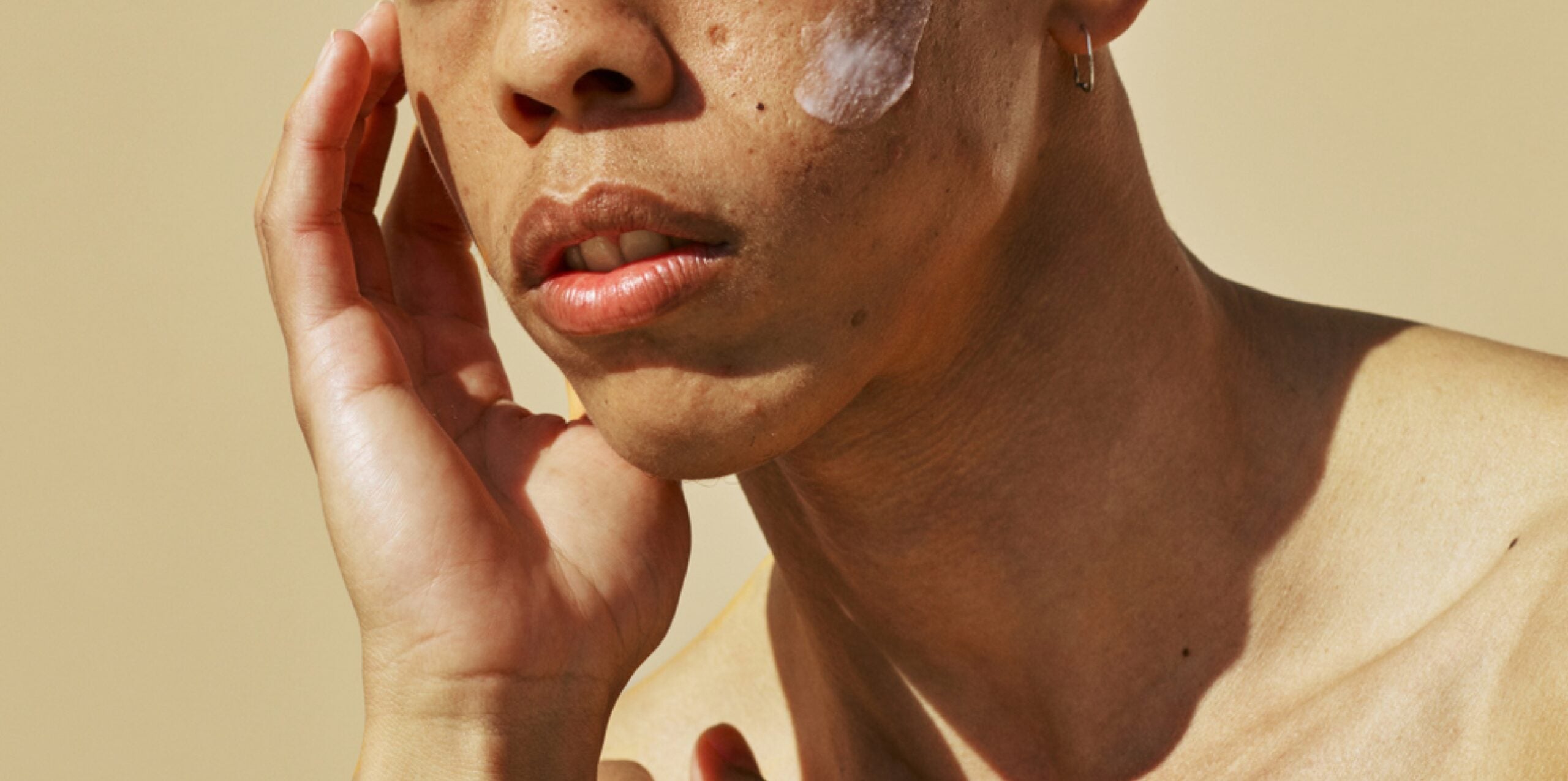 Have cystic acne? This 'anti-steroid steroid' can be the breakthrough you’ve been waiting for