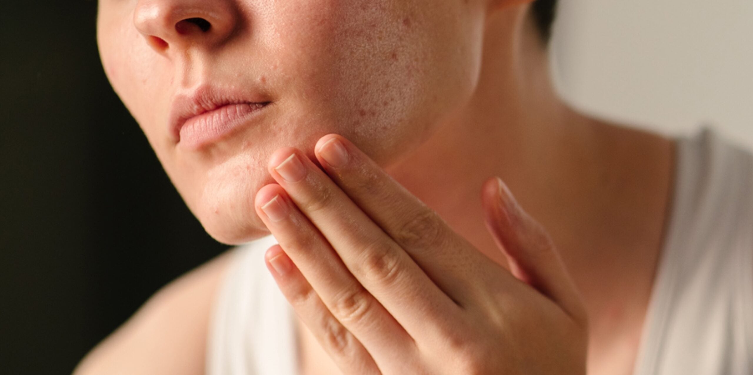 Dark spots, explained: What causes hyperpigmentation, and how do you treat it?