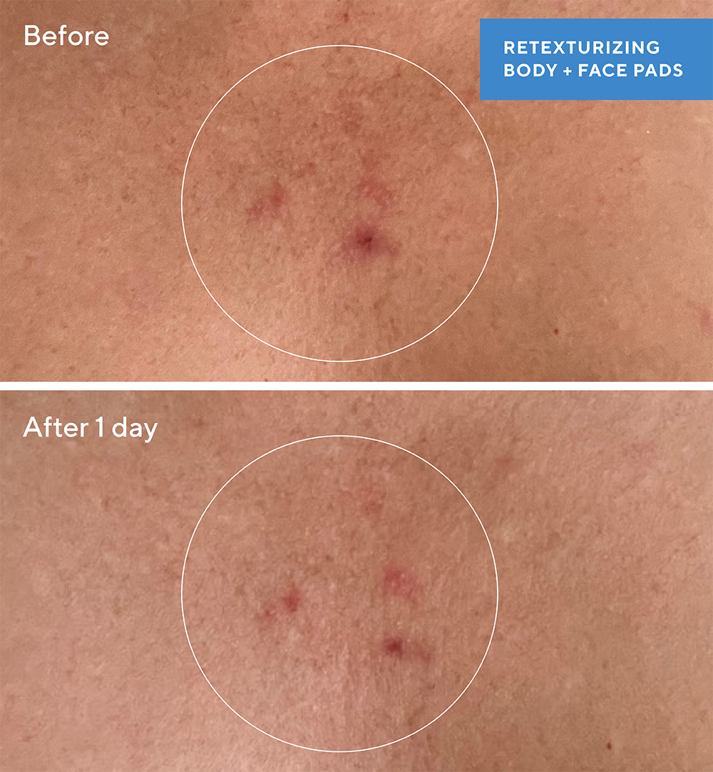 close up before and after 1 day using Murad Retinizing Body Pads