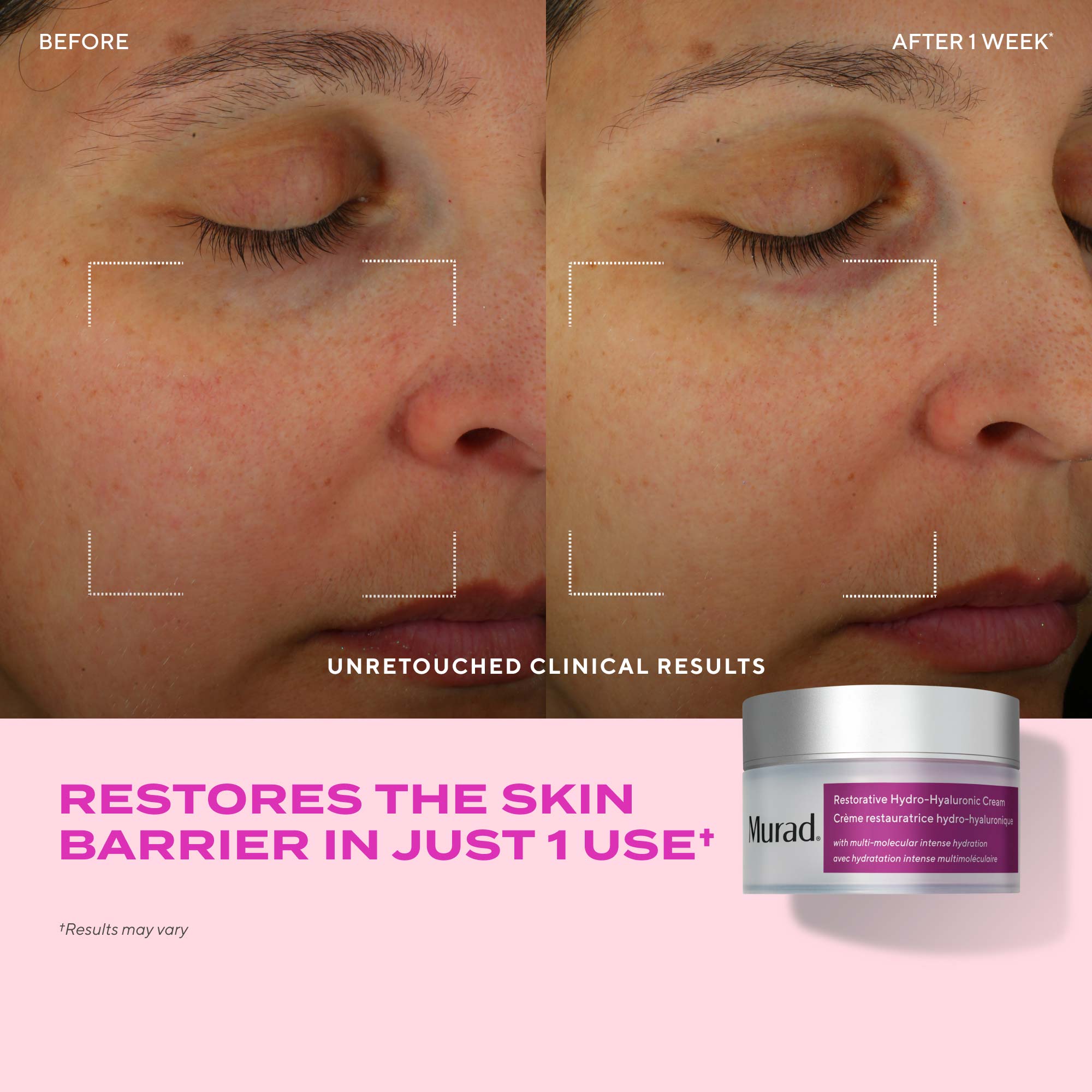 before and after of woman after 1 week with less irritated skin with text highlighting benefit: restores the skin barrierin just 1 use