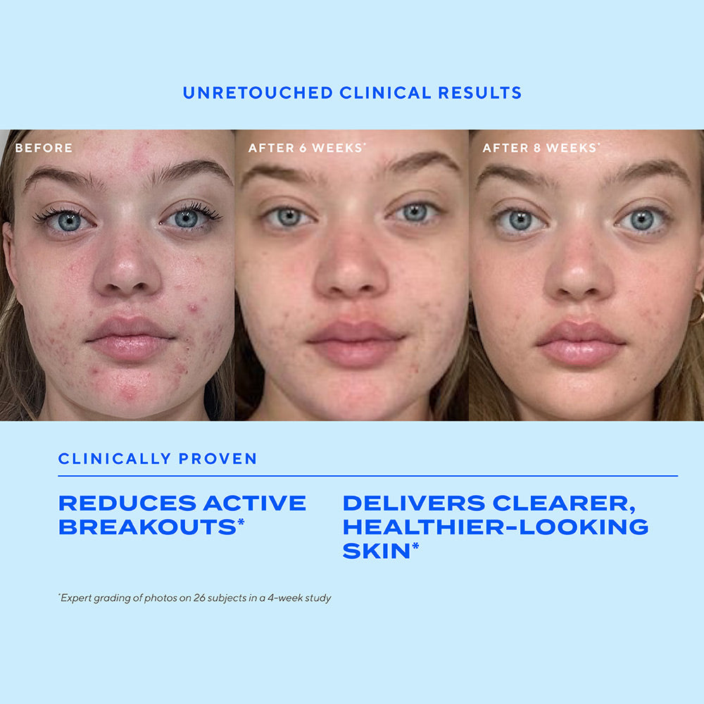 Biome-Balancing Clear & Prevent Acne Treatment Serum before and after showing girl with acne