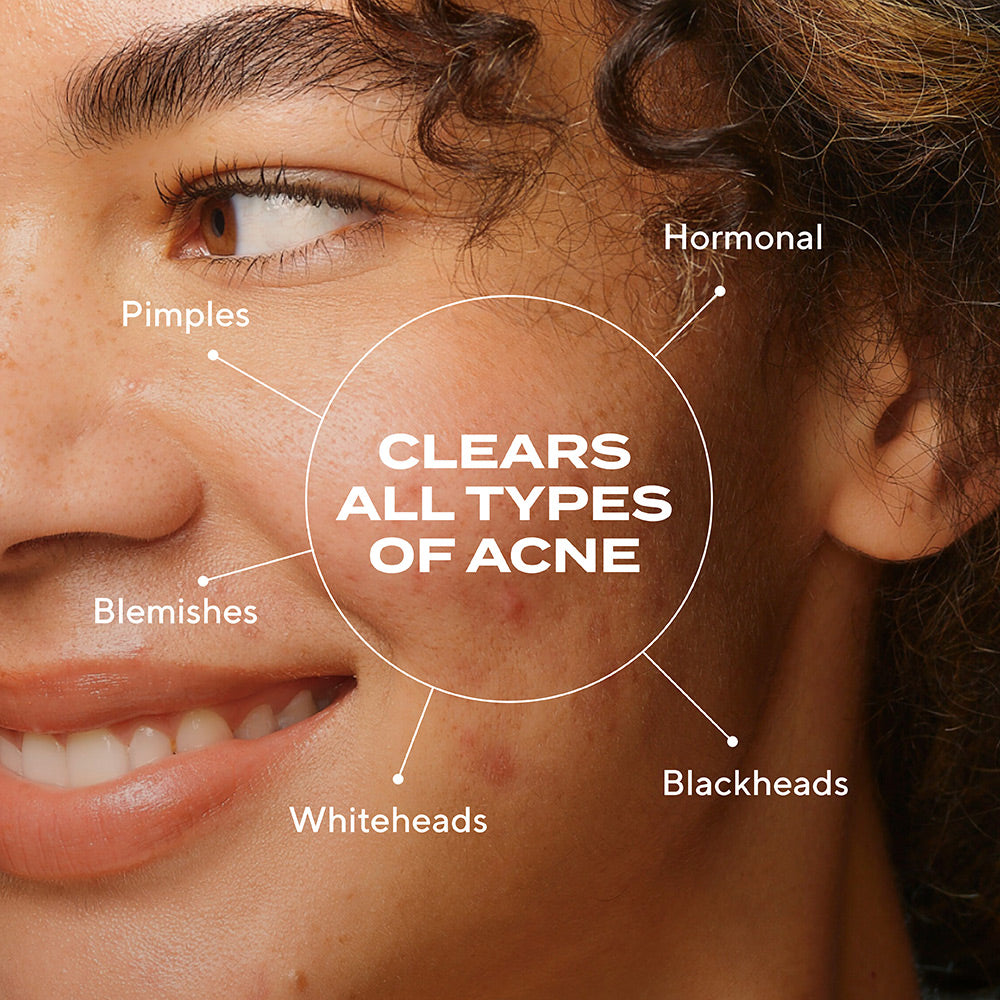 young woman with acne scars