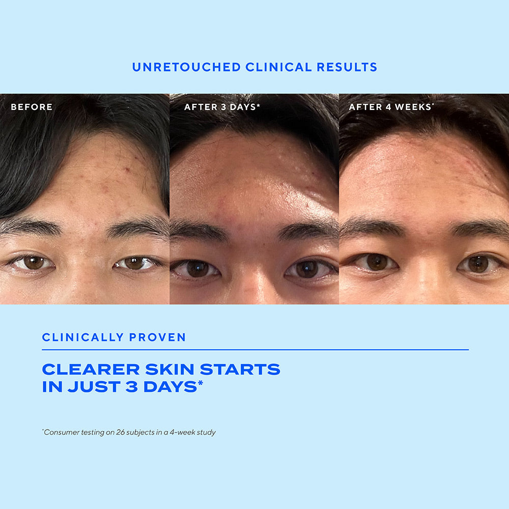Biome-Balancing Clear & Prevent Acne Treatment Serum before and after over 4 weeks showing young man with acne progress