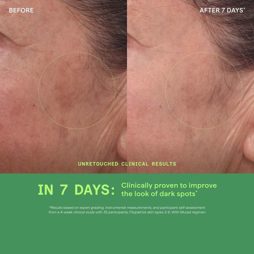 Before and after comparison of skin with dark spots, showing improvement in 7 days.