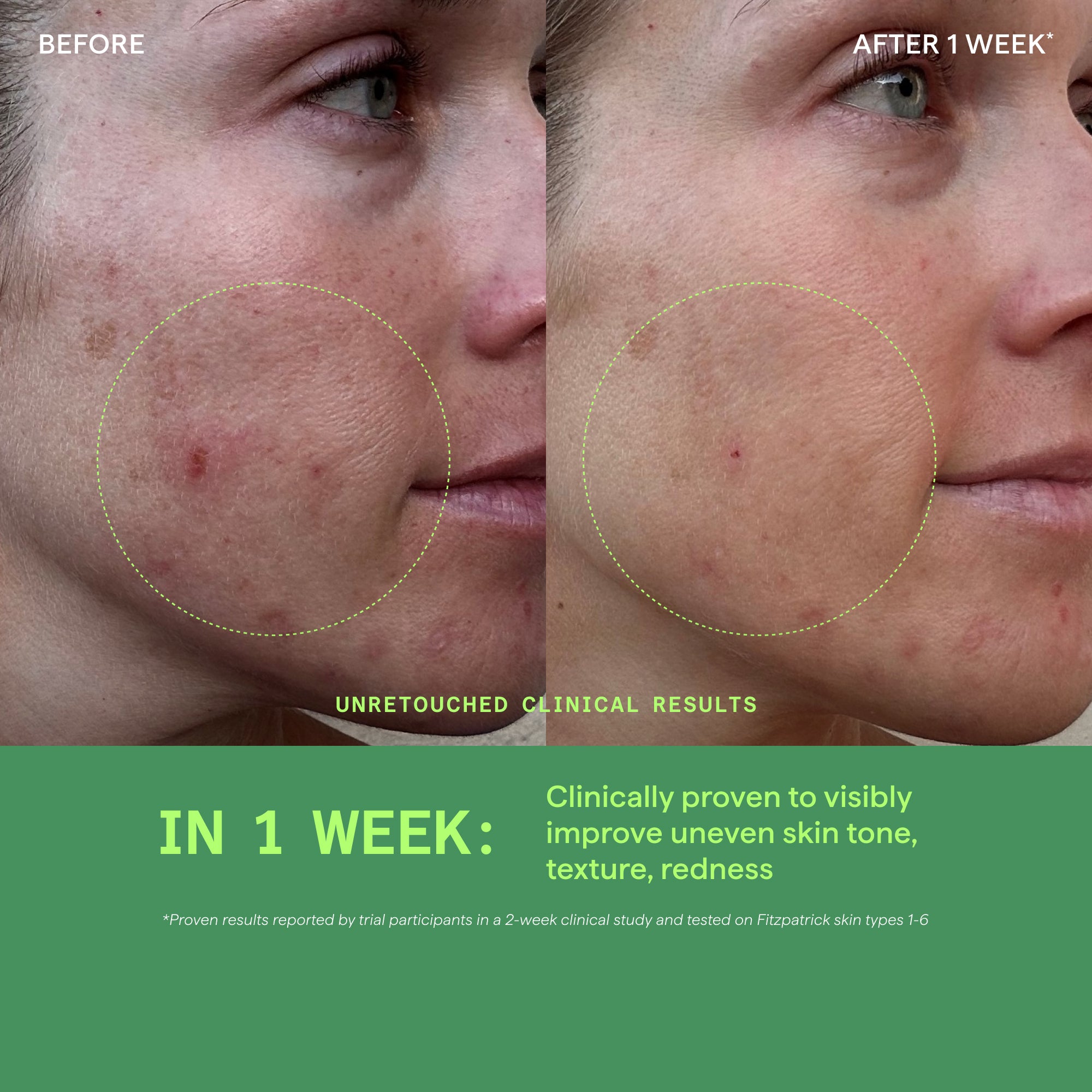 Before and after comparison of skin treatment showing reduced acne and redness.