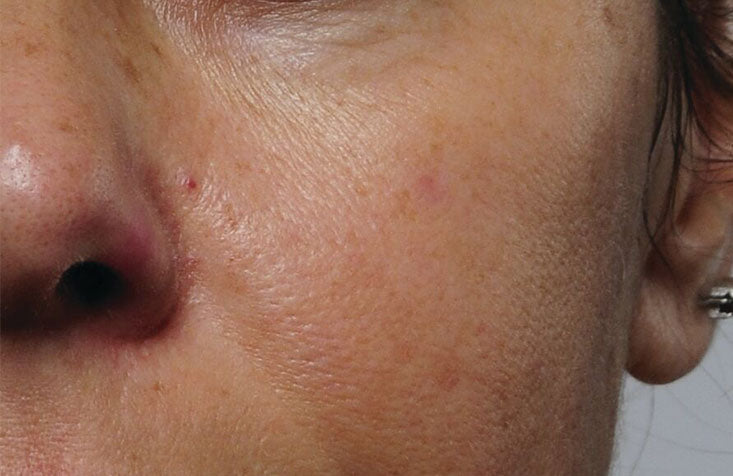 Rapid_Collagen_Infusion_After_733x476_728d9c5f-f1c1-40a8-9ecc-668bce8c6e35